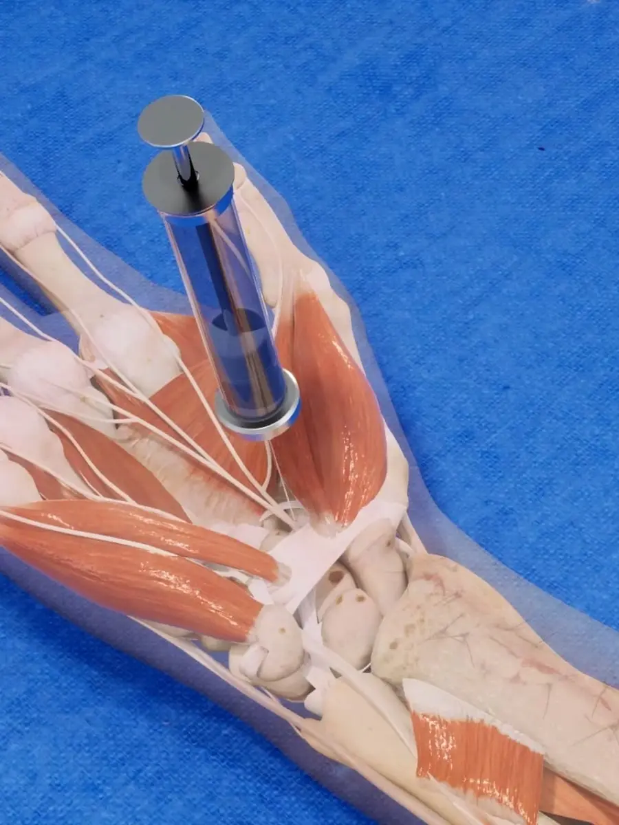 Wrist anatomy with a surgical device, medical device animation