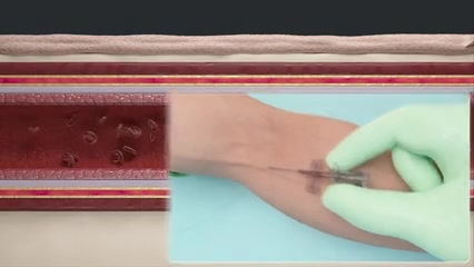 IV catheter insertion system — medical device animation