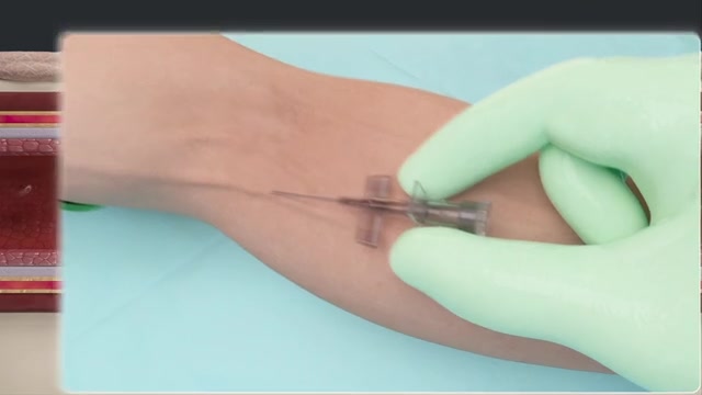 IV Catheter Insertion System -- Medical Devices animation