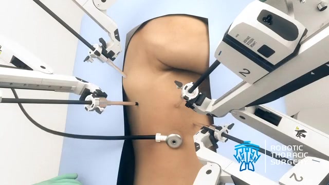 Robotic Thoracic Surgery -- Medical & Surgical animation