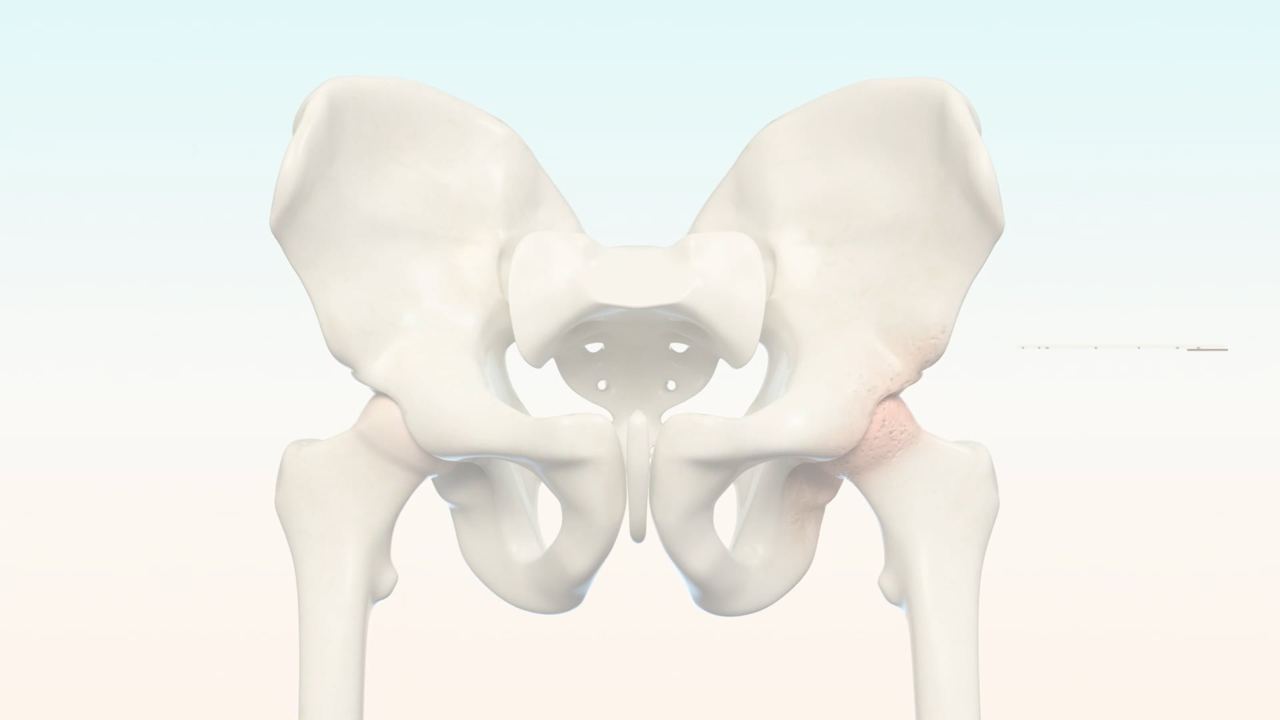 Direct Anterior Total Hip Arthroplasty, Medical & Surgical animation
